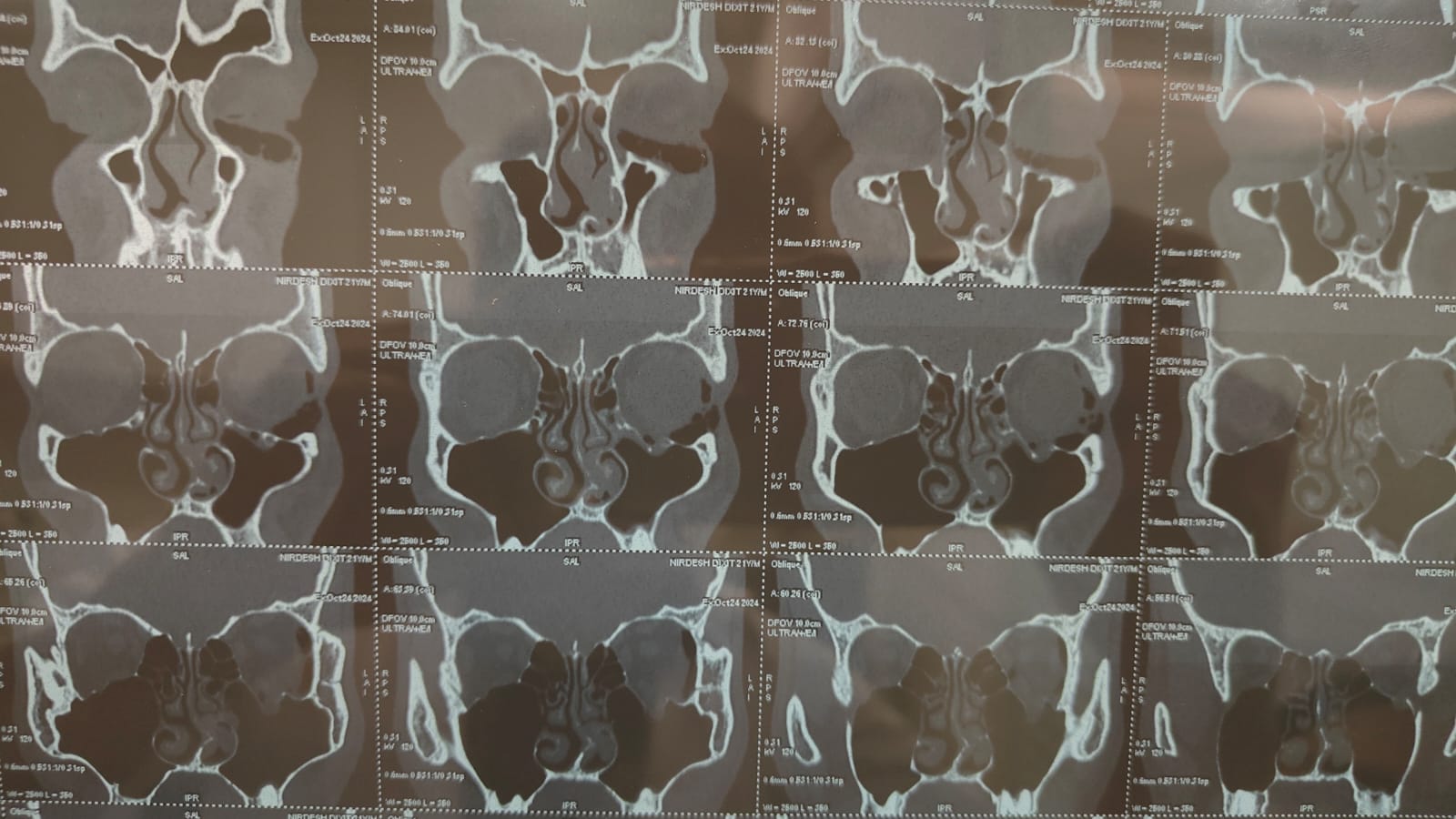 CT scan showing blow out fracture